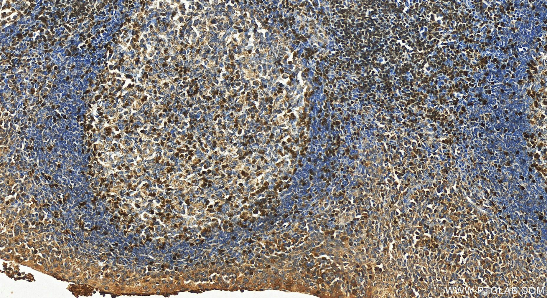 IHC staining of human tonsillitis using 14464-1-AP