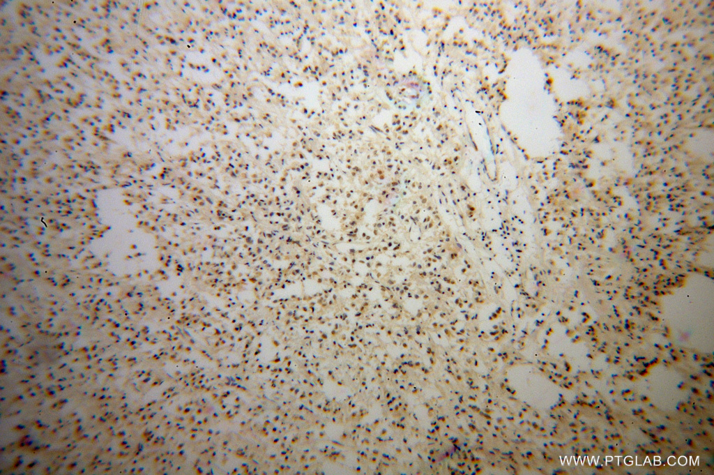 IHC staining of human breast cancer using 14519-1-AP