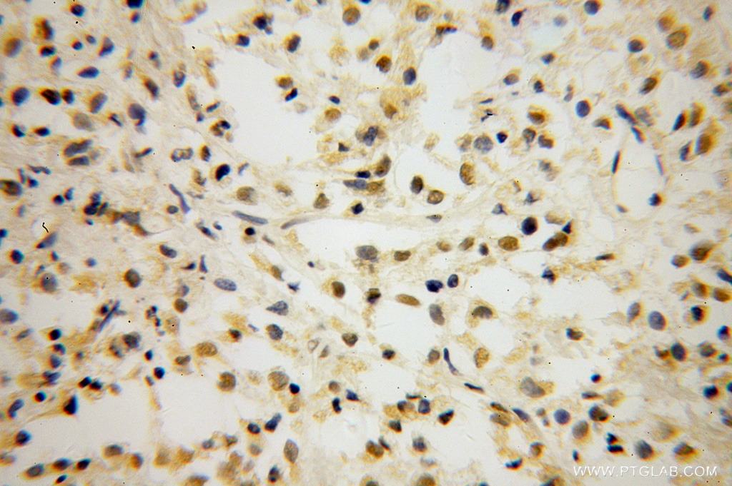 IHC staining of human breast cancer using 14519-1-AP