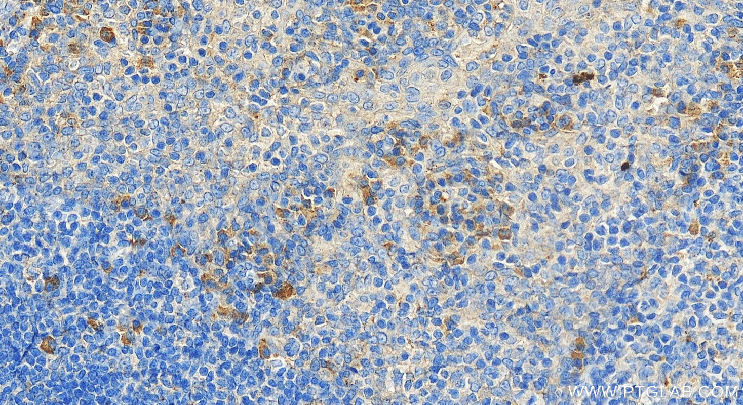 Immunohistochemical analysis of paraffin-embedded human tonsillitis tissue slide using 16078-1-AP (TCN1 antibody) at dilution of 1:400 (under 20x lens). Heat mediated antigen retrieval with Tris-EDTA buffer (pH 9.0). IHC staining of human tonsillitis using 16078-1-AP