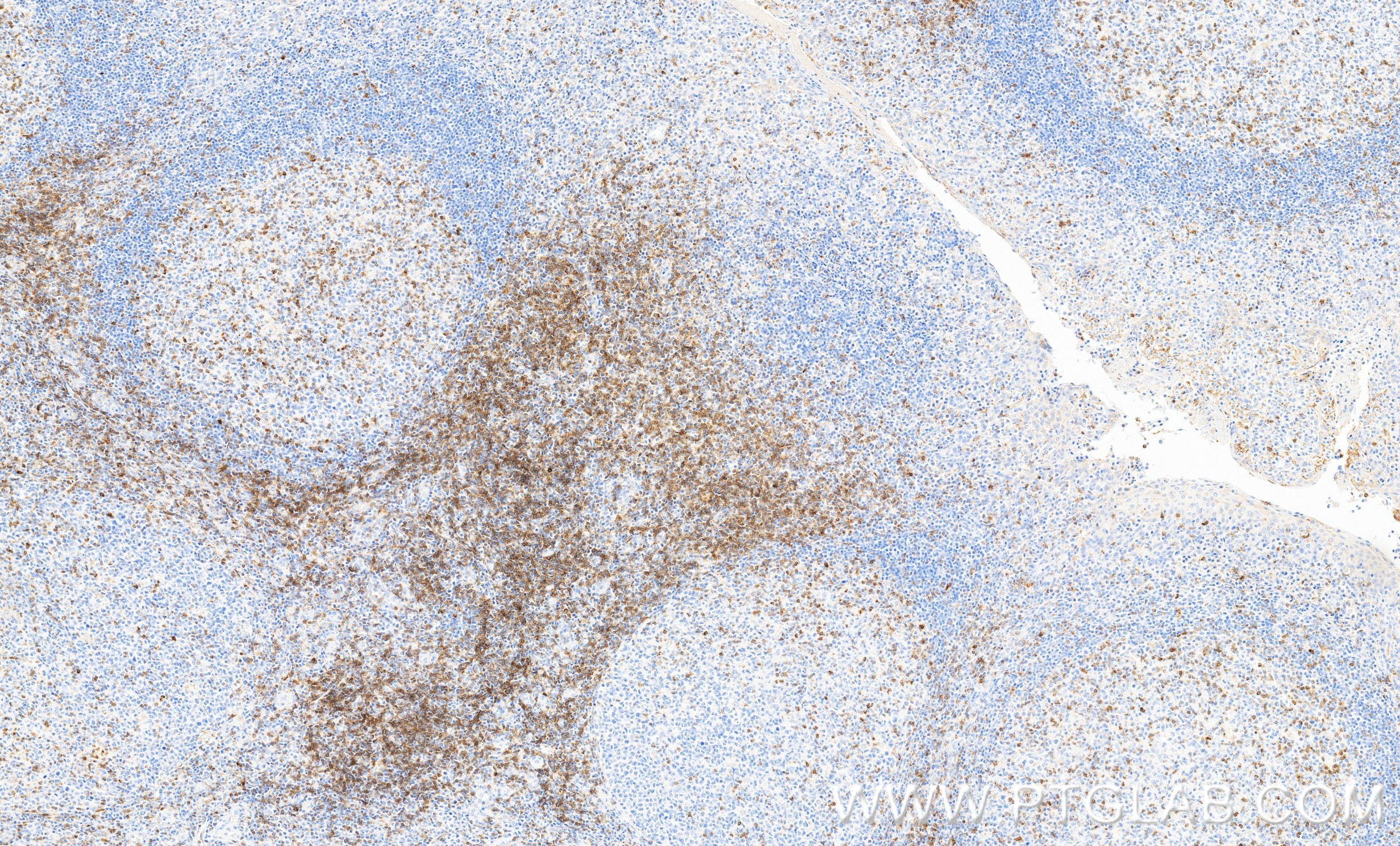 IHC staining of human tonsillitis using 87509-1-RR IHC staining of human tonsillitis using 87509-1-RR