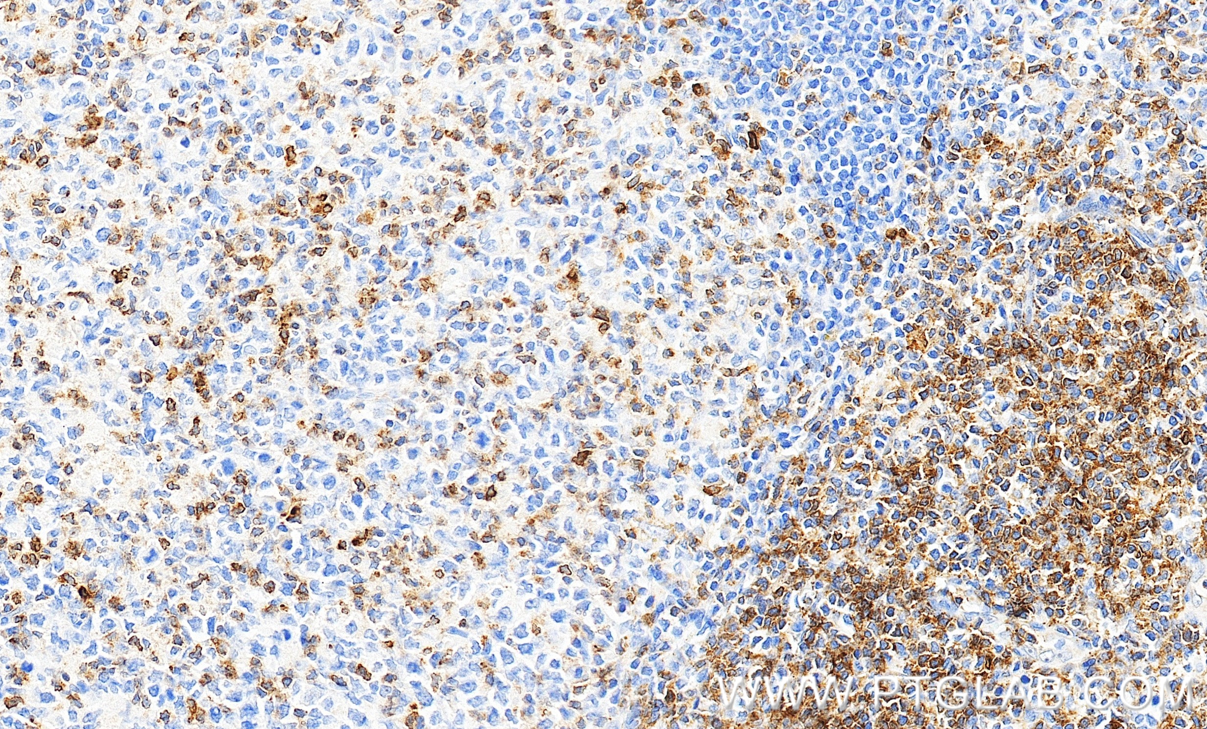 IHC staining of human tonsillitis using 87509-1-RR IHC staining of human tonsillitis using 87509-1-RR
