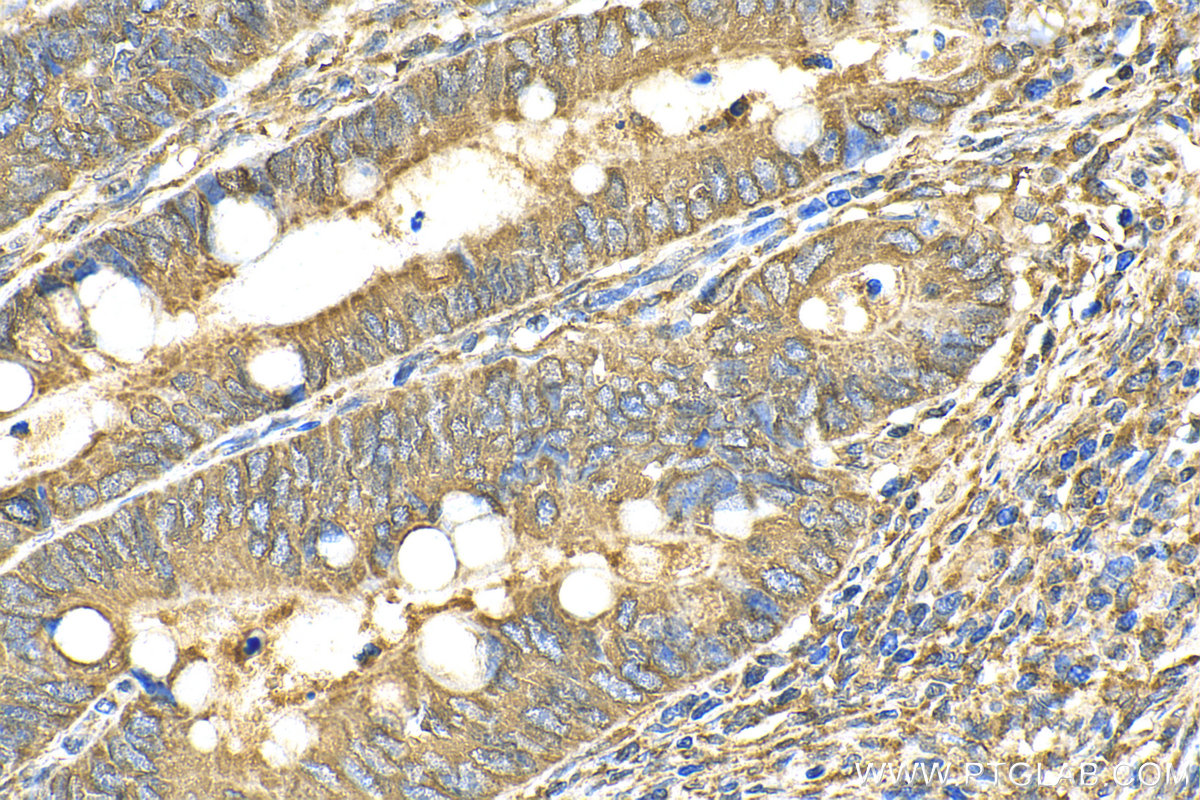 IHC staining of human colon cancer using 82120-1-RR (same clone as 82120-1-PBS)
