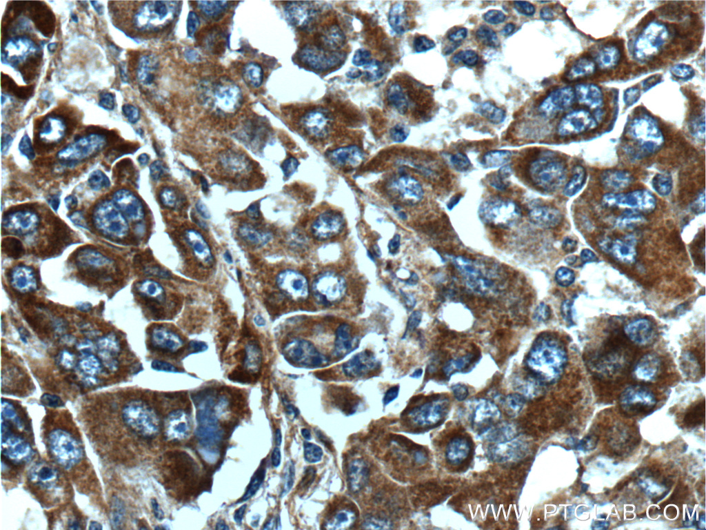 IHC staining of human liver cancer using 15880-1-AP