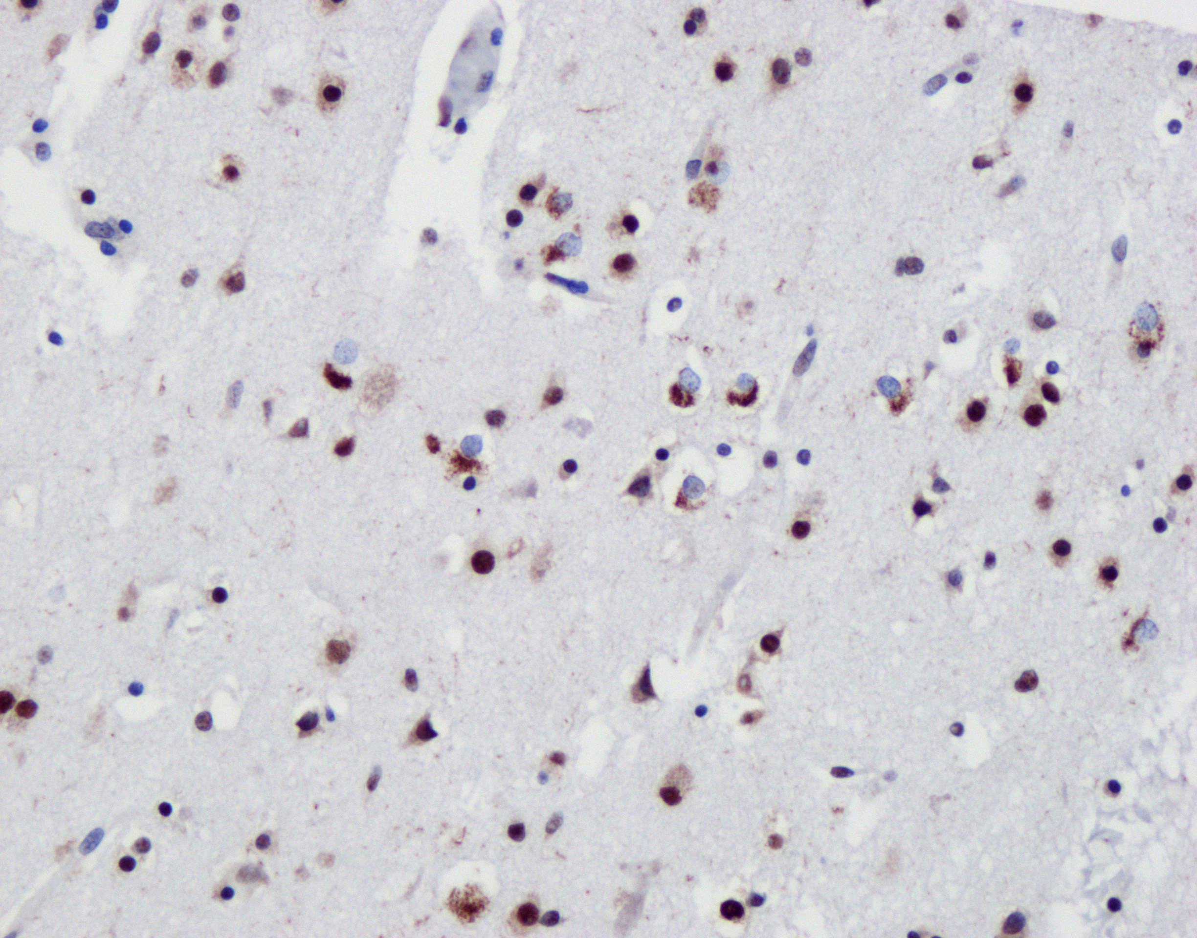 IHC staining of frontal cortex from FTLD-TDP type B using 80001-1-RR (same clone as 80001-1-PBS)