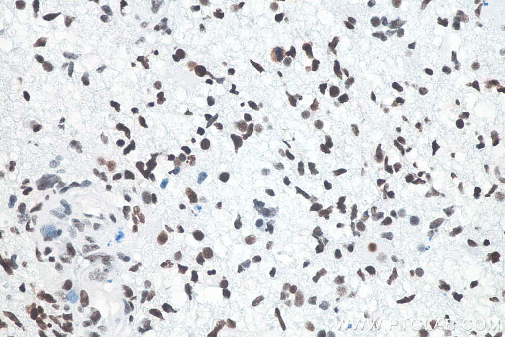 IHC staining of human gliomas using 80001-1-RR IHC staining of human gliomas using 80001-1-RR