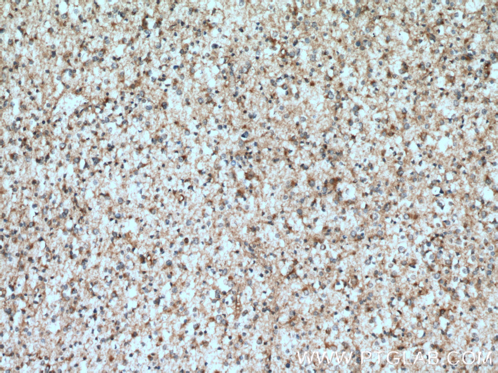 IHC staining of human gliomas using 13528-1-AP