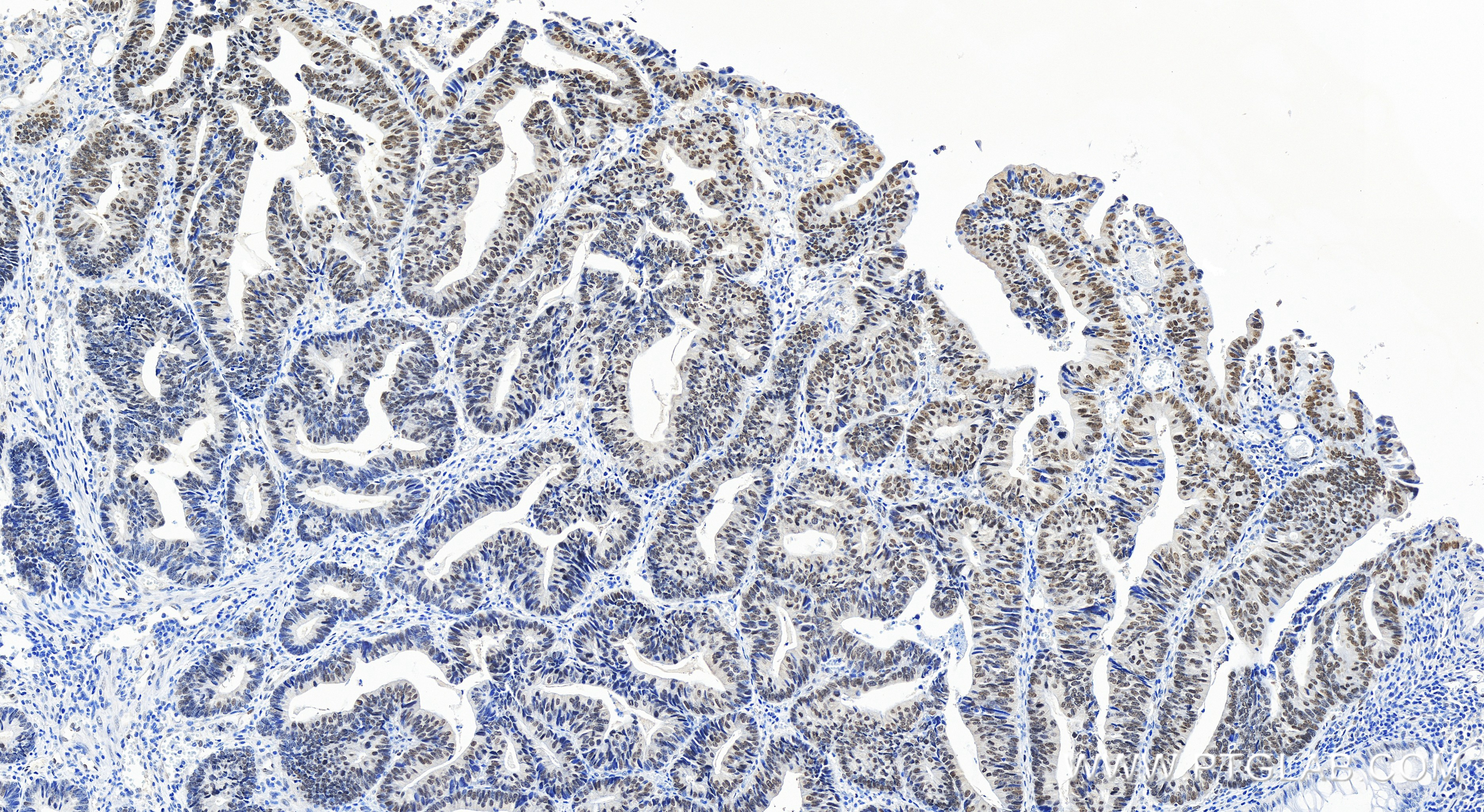 IHC staining of human colon cancer using 84932-4-RR (same clone as 84932-4-PBS)