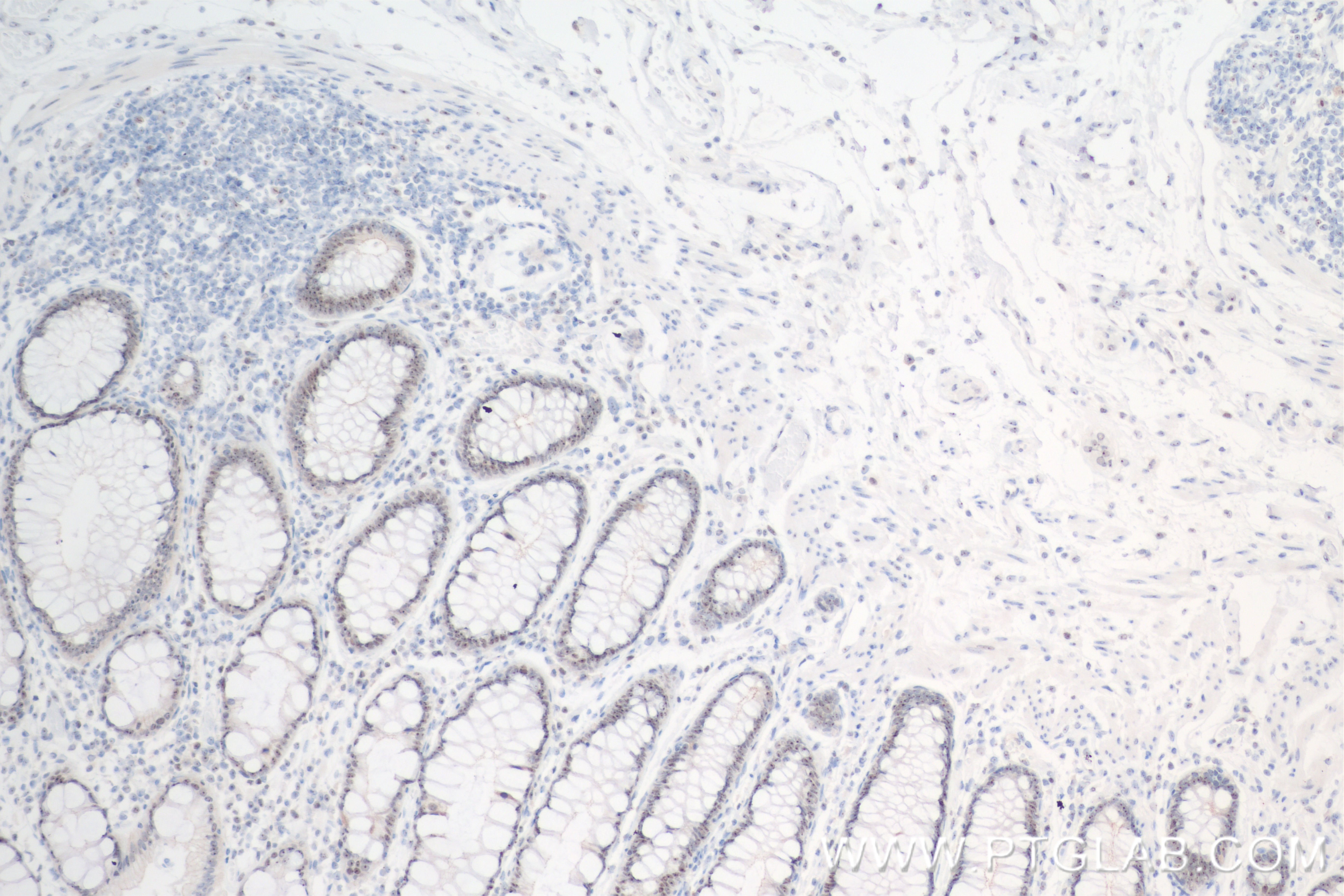 IHC staining of human rectal cancer using 84636-1-RR