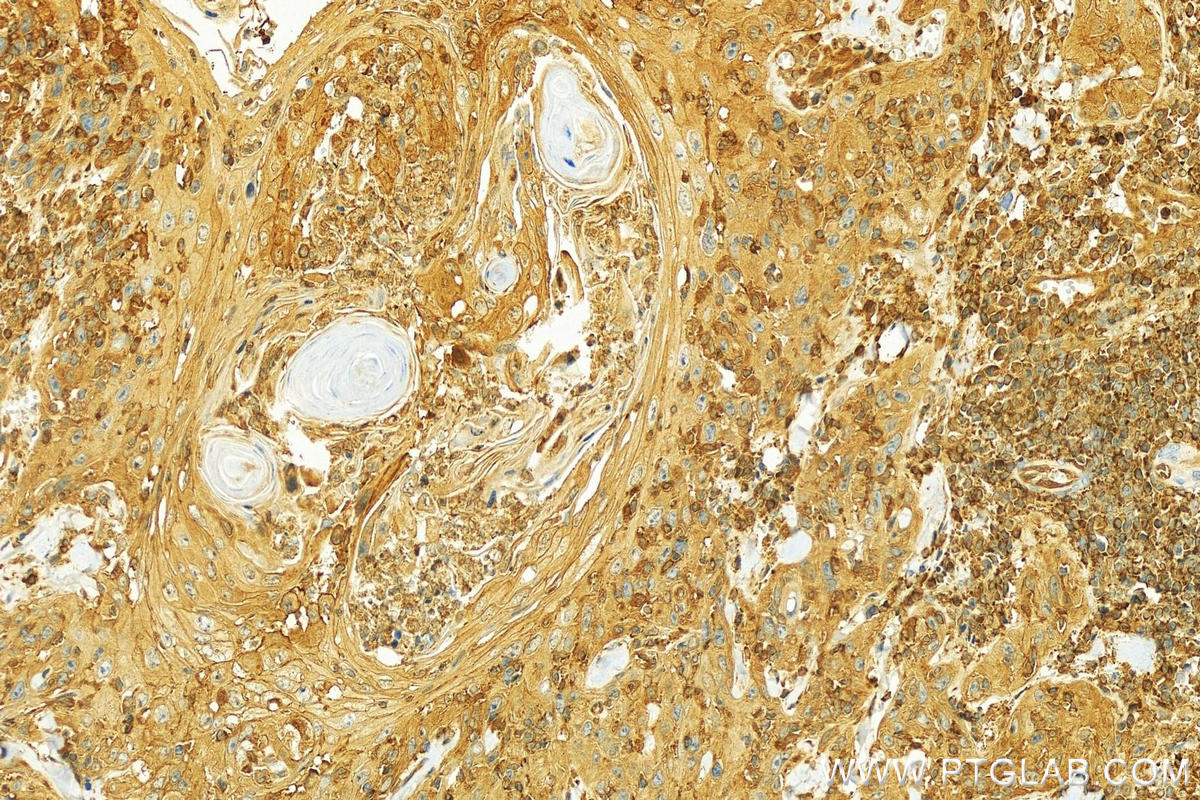 IHC staining of human skin cancer using 10258-1-AP
