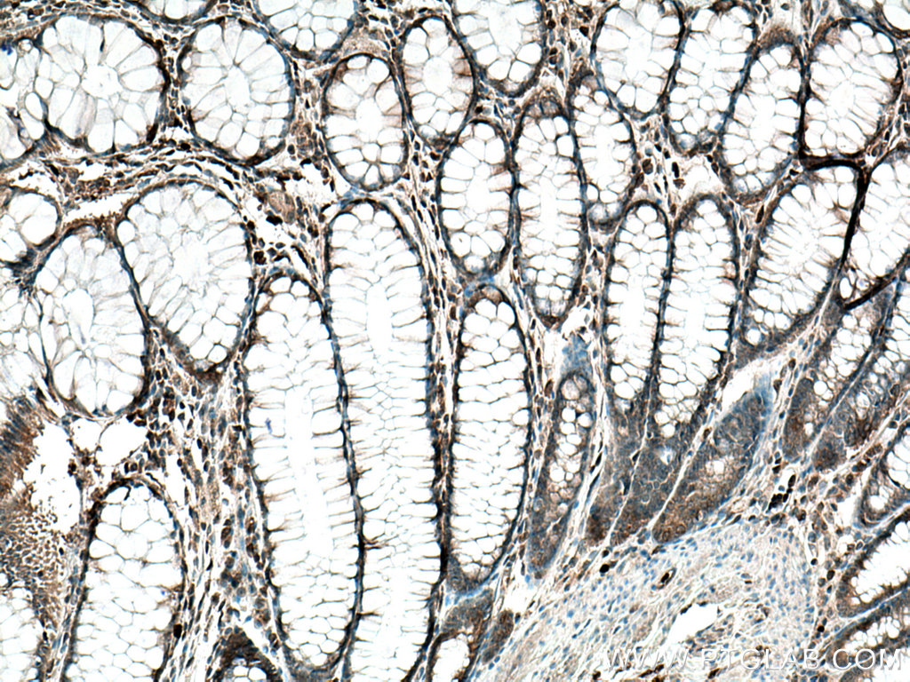 IHC staining of human colon cancer using 11125-1-AP