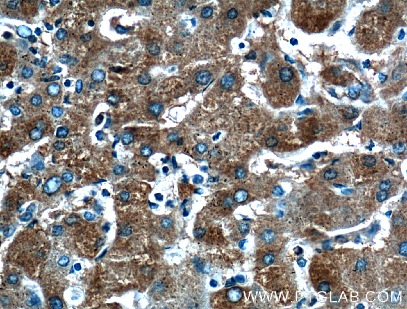 IHC staining of human hepatocirrhosis using 17435-1-AP (same clone as 17435-1-PBS)