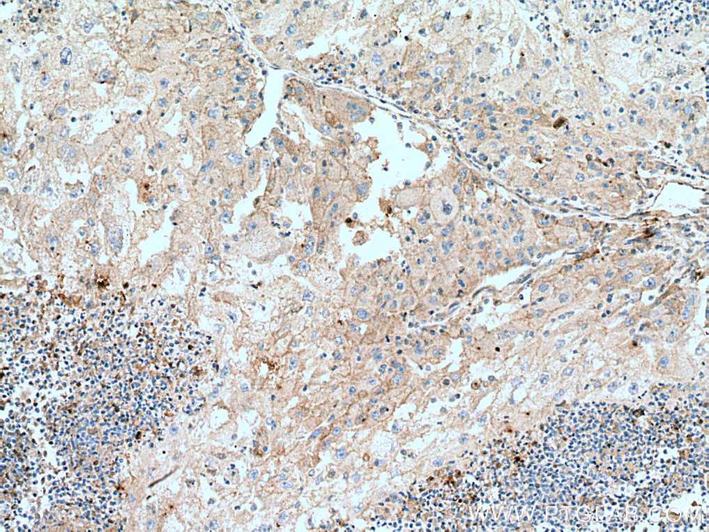 IHC staining of human liver cancer using 66171-1-Ig (same clone as 66171-1-PBS)