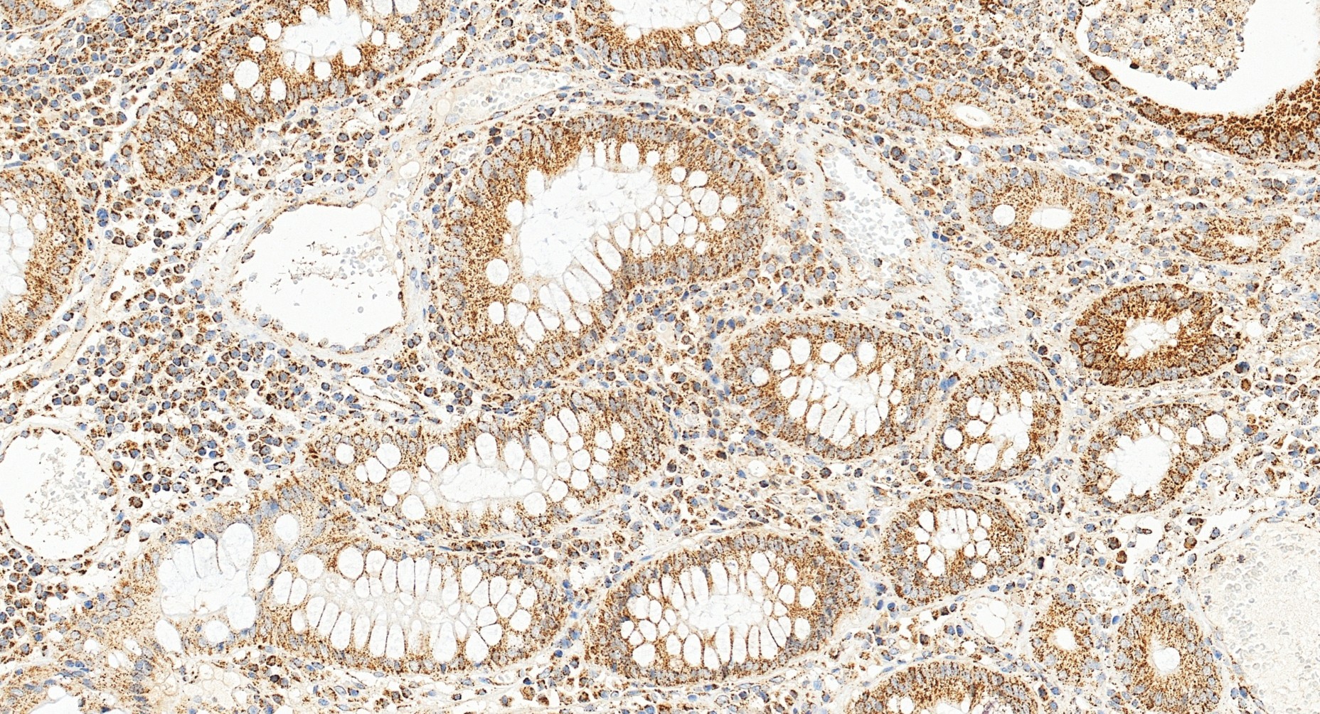 Immunohistochemical analysis of paraffin-embedded human colon cancer tissue slide using 22586-1-AP (TFAM antibody) at dilution of 1:2000 (under 20x lens). Heat mediated antigen retrieval with Tris-EDTA buffer (pH 9.0). IHC staining of human colon cancer using 22586-1-AP