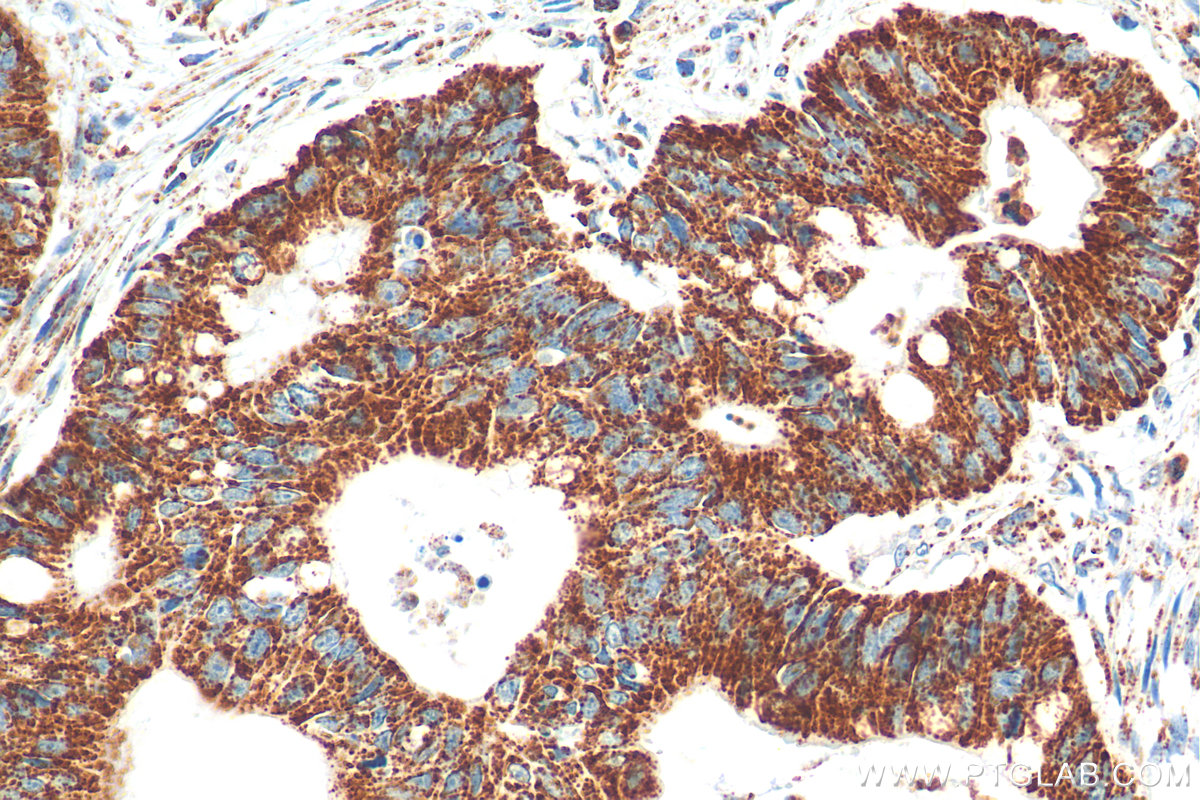 IHC staining of human colon cancer using 22586-1-AP