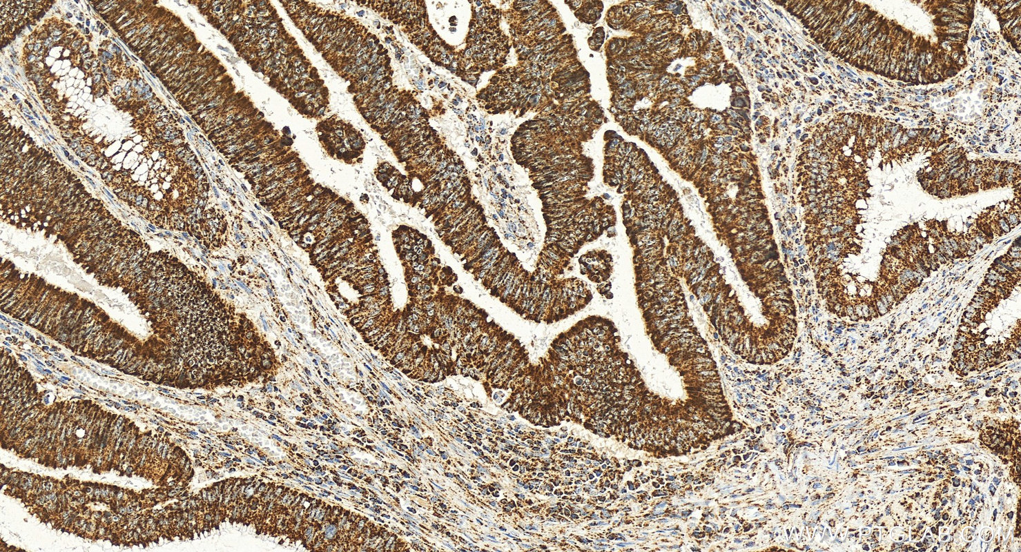 IHC staining of human colon cancer using 68557-5-Ig