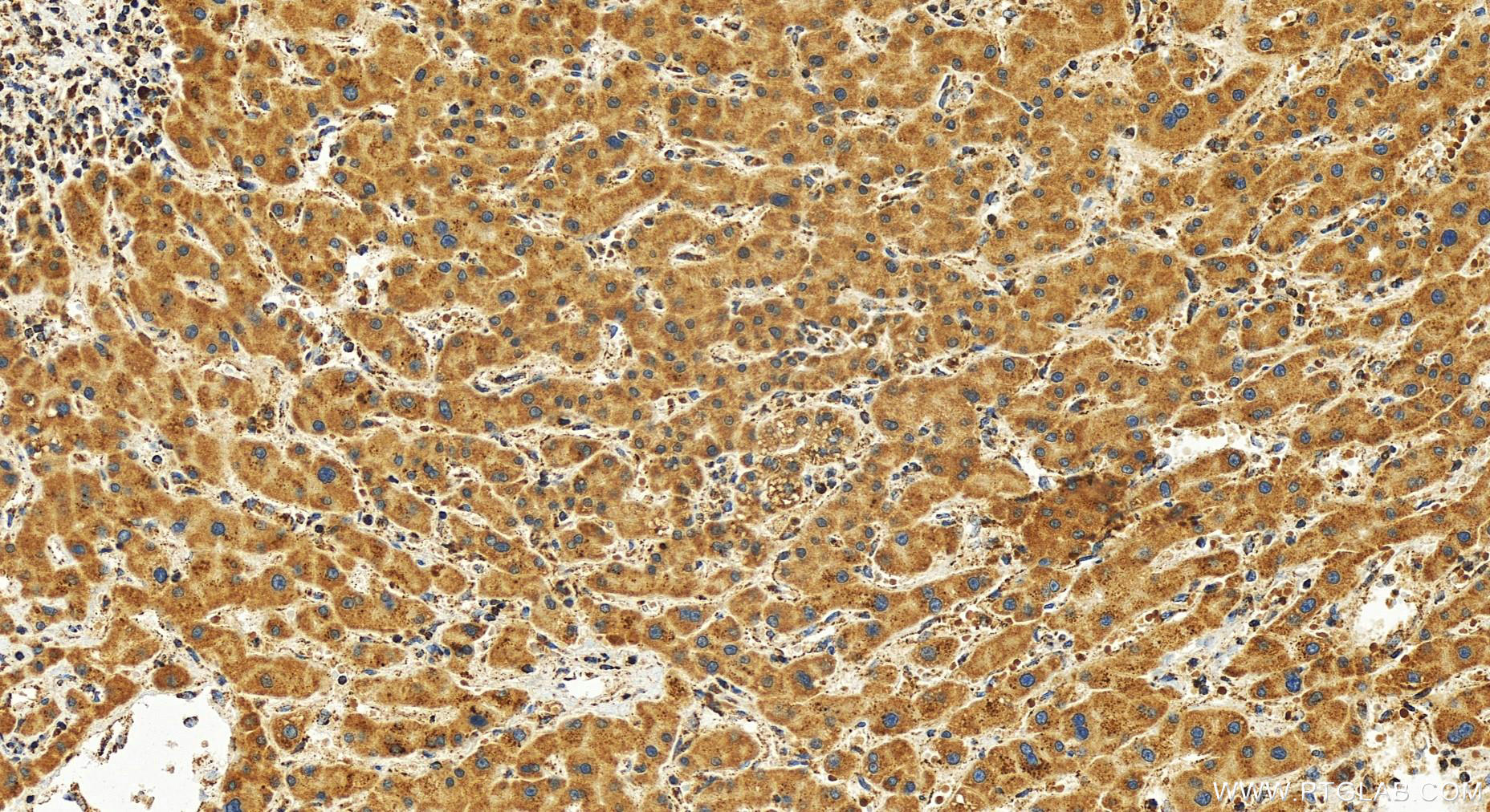 IHC staining of human intrahepatic cholangiocarcinoma using 82745-1-RR (same clone as 82745-1-PBS)