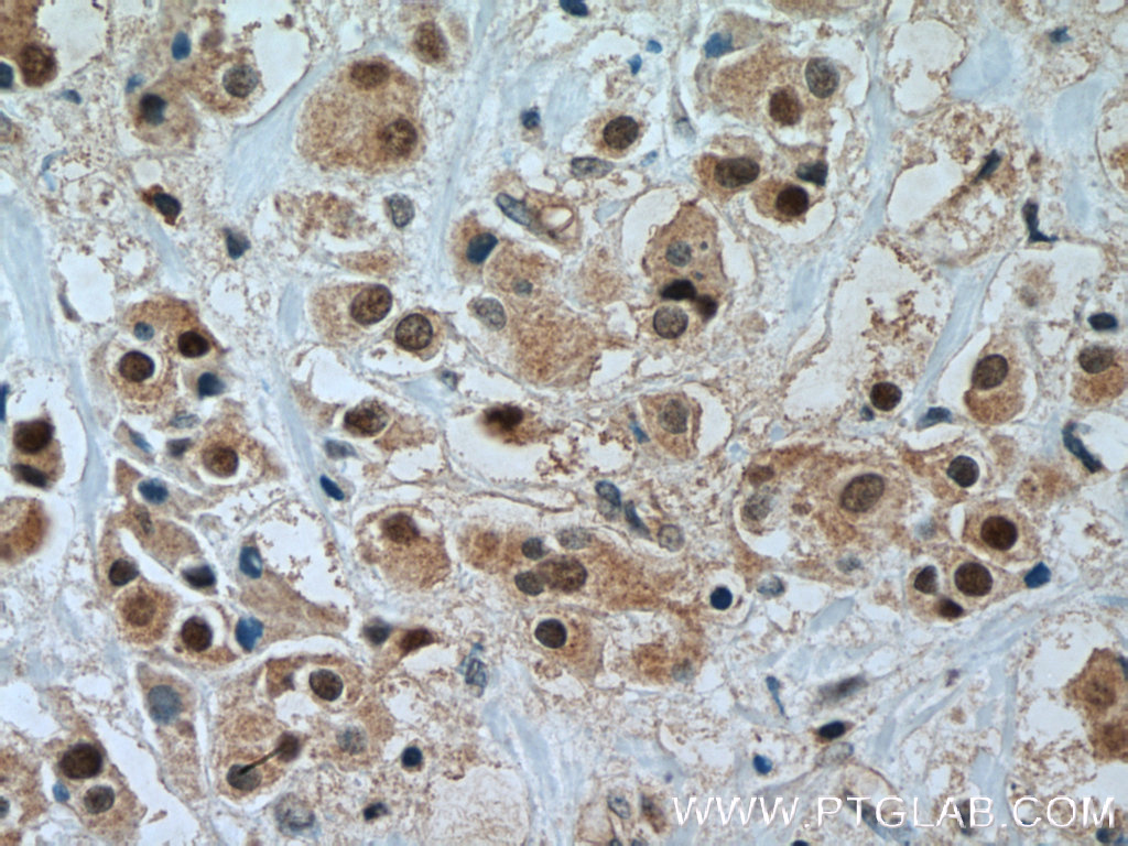 IHC staining of human breast cancer using 14572-1-AP