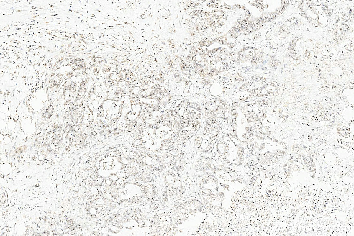 IHC staining of human colon cancer using 11043-1-AP IHC staining of human colon cancer using 11043-1-AP