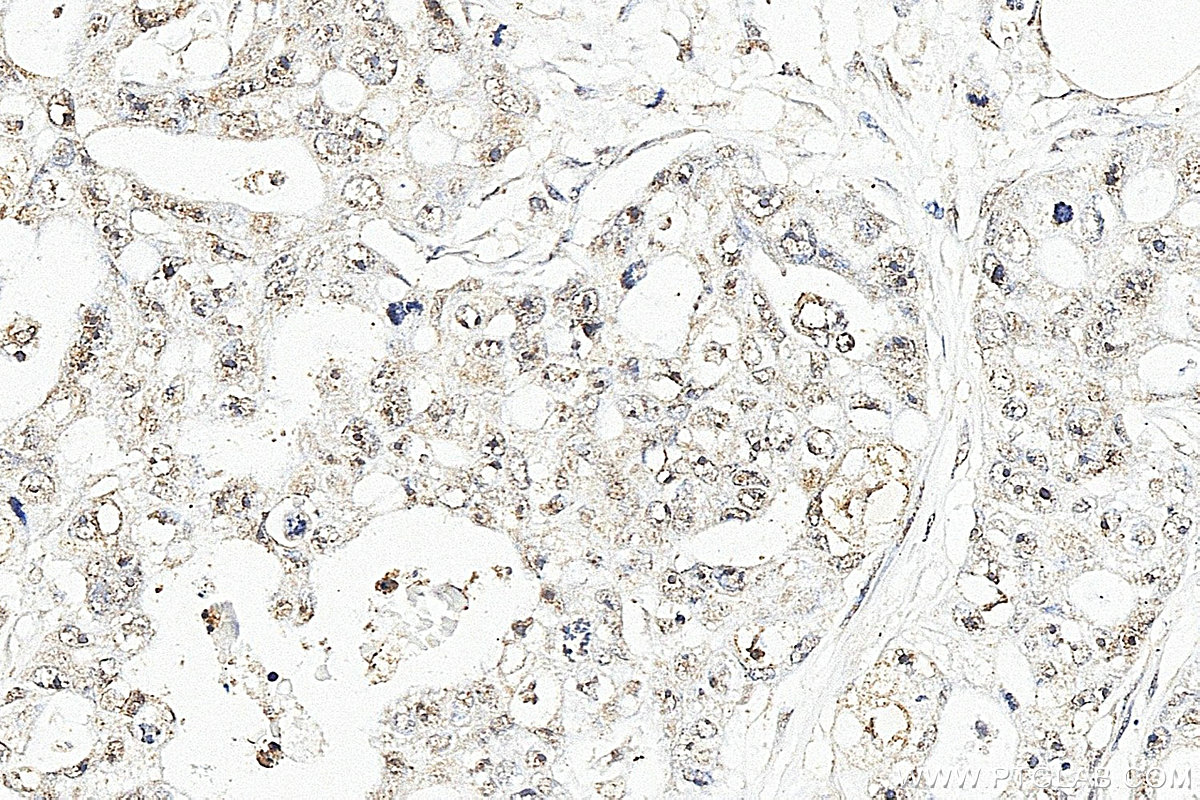 IHC staining of human colon cancer using 11043-1-AP IHC staining of human colon cancer using 11043-1-AP