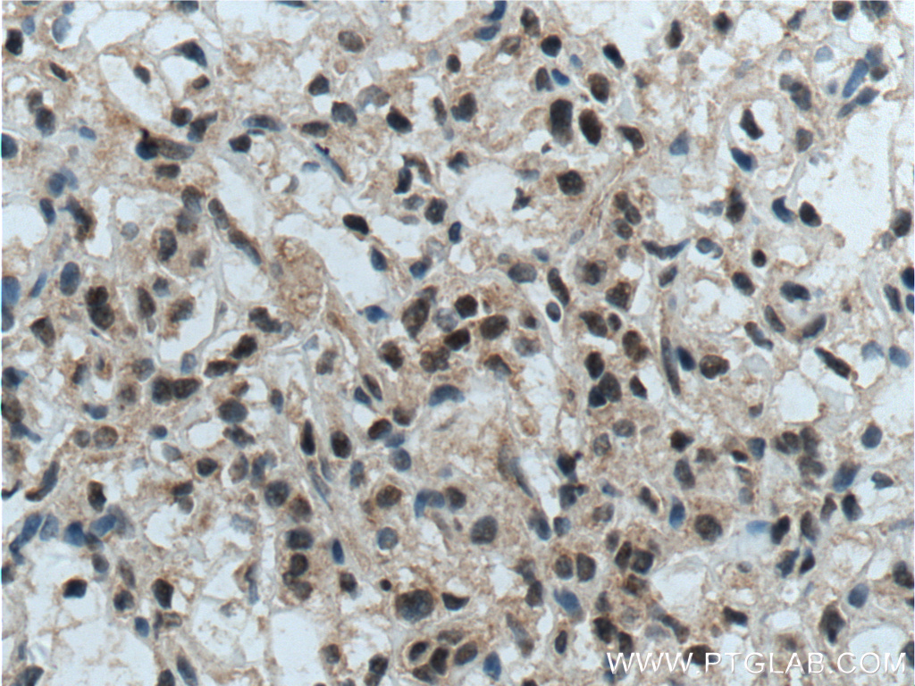 IHC staining of human renal cell carcinoma using 14480-1-AP