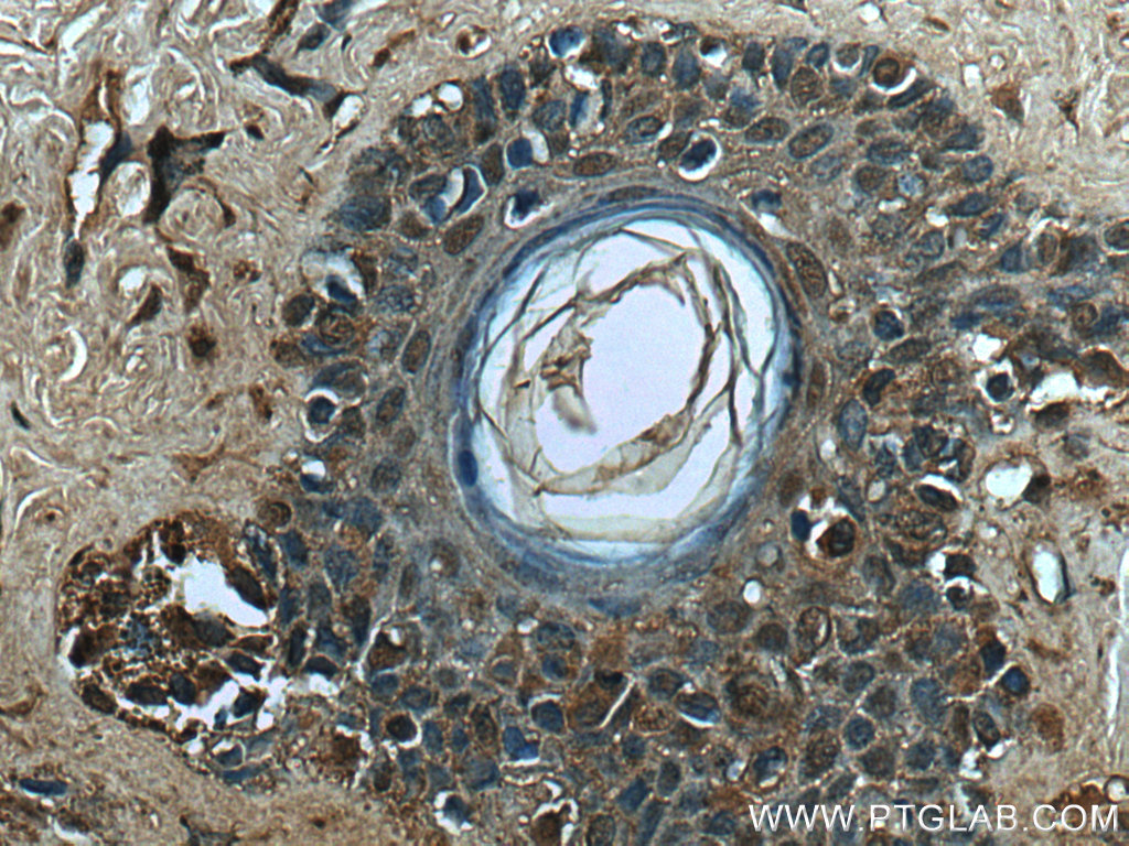 IHC staining of human malignant melanoma using 67319-1-Ig (same clone as 67319-1-PBS)
