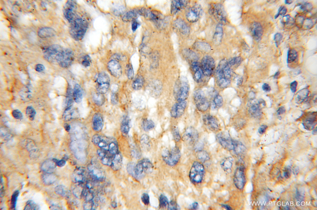 IHC staining of human gliomas using 11571-1-AP