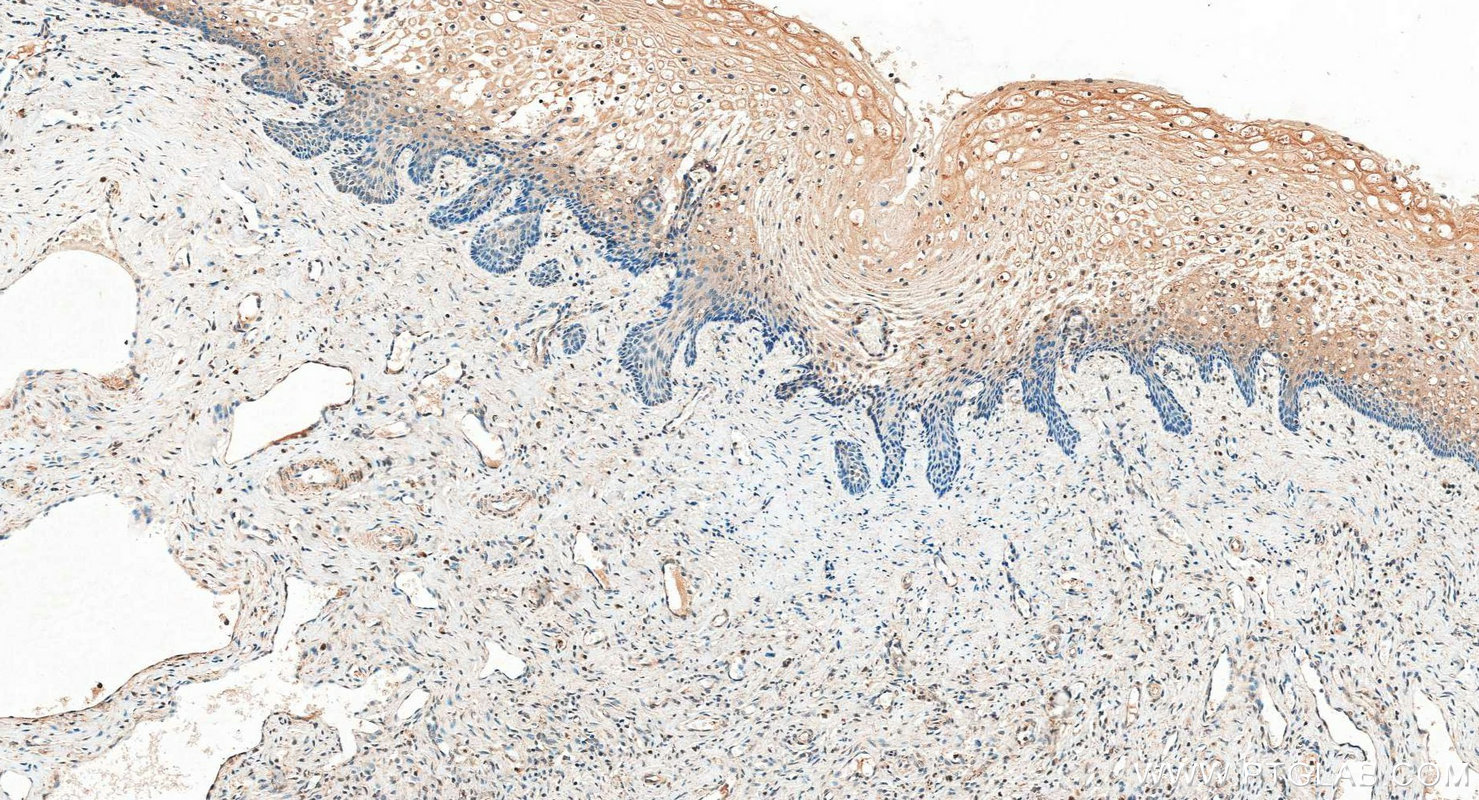 IHC staining of human cervical cancer using 30689-1-AP (same clone as 30689-1-PBS) IHC staining of human cervical cancer using 30689-1-AP (same clone as 30689-1-PBS)