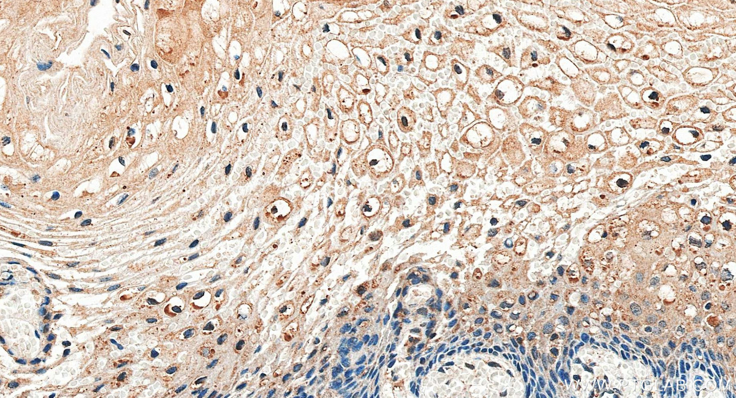 IHC staining of human cervical cancer using 30689-1-AP (same clone as 30689-1-PBS) IHC staining of human cervical cancer using 30689-1-AP (same clone as 30689-1-PBS)