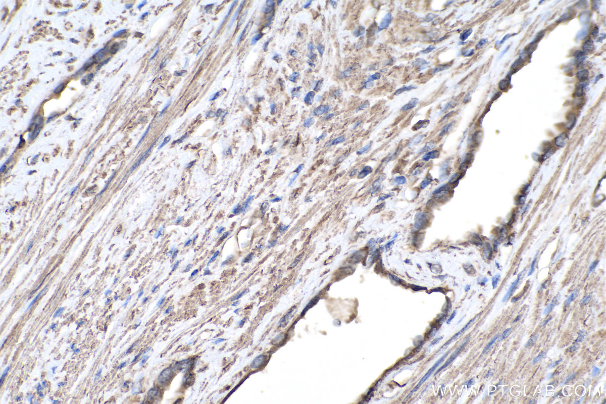 IHC staining of human prostate cancer using 69012-1-Ig