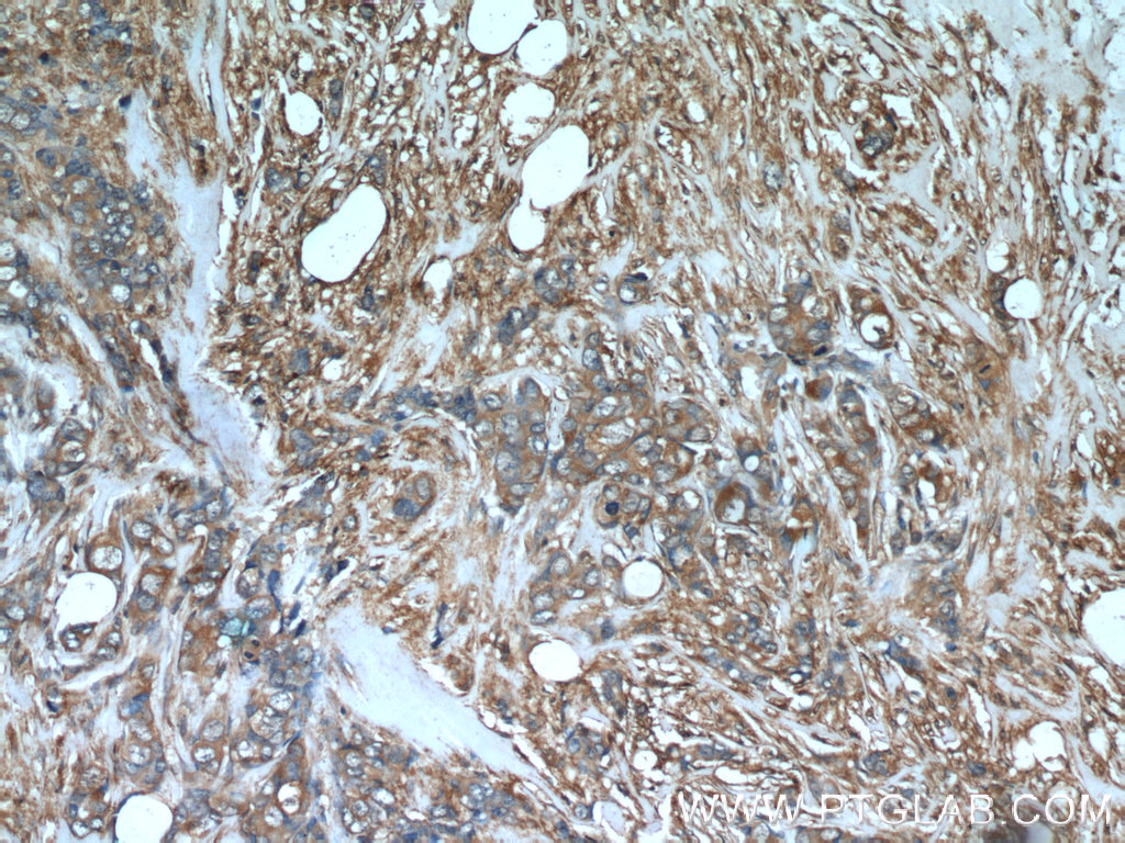 IHC staining of human breast cancer using 22308-1-AP (same clone as 22308-1-PBS)