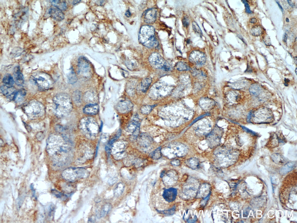 IHC staining of human breast cancer using 22308-1-AP