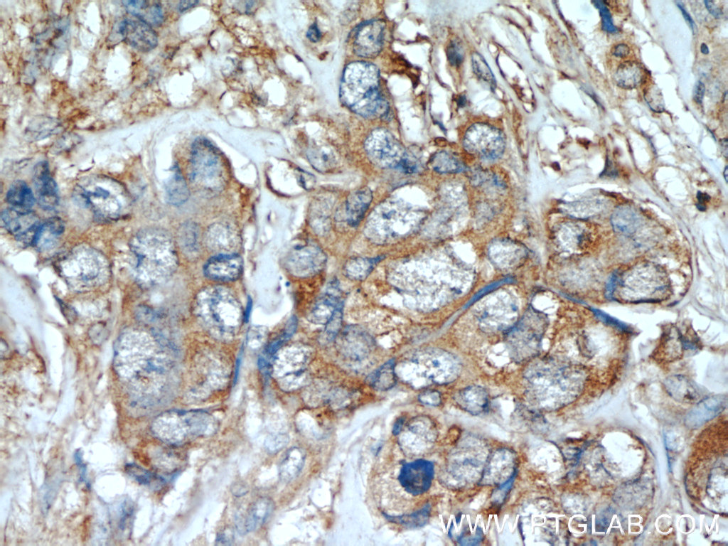 IHC staining of human breast cancer using 22308-1-AP (same clone as 22308-1-PBS)