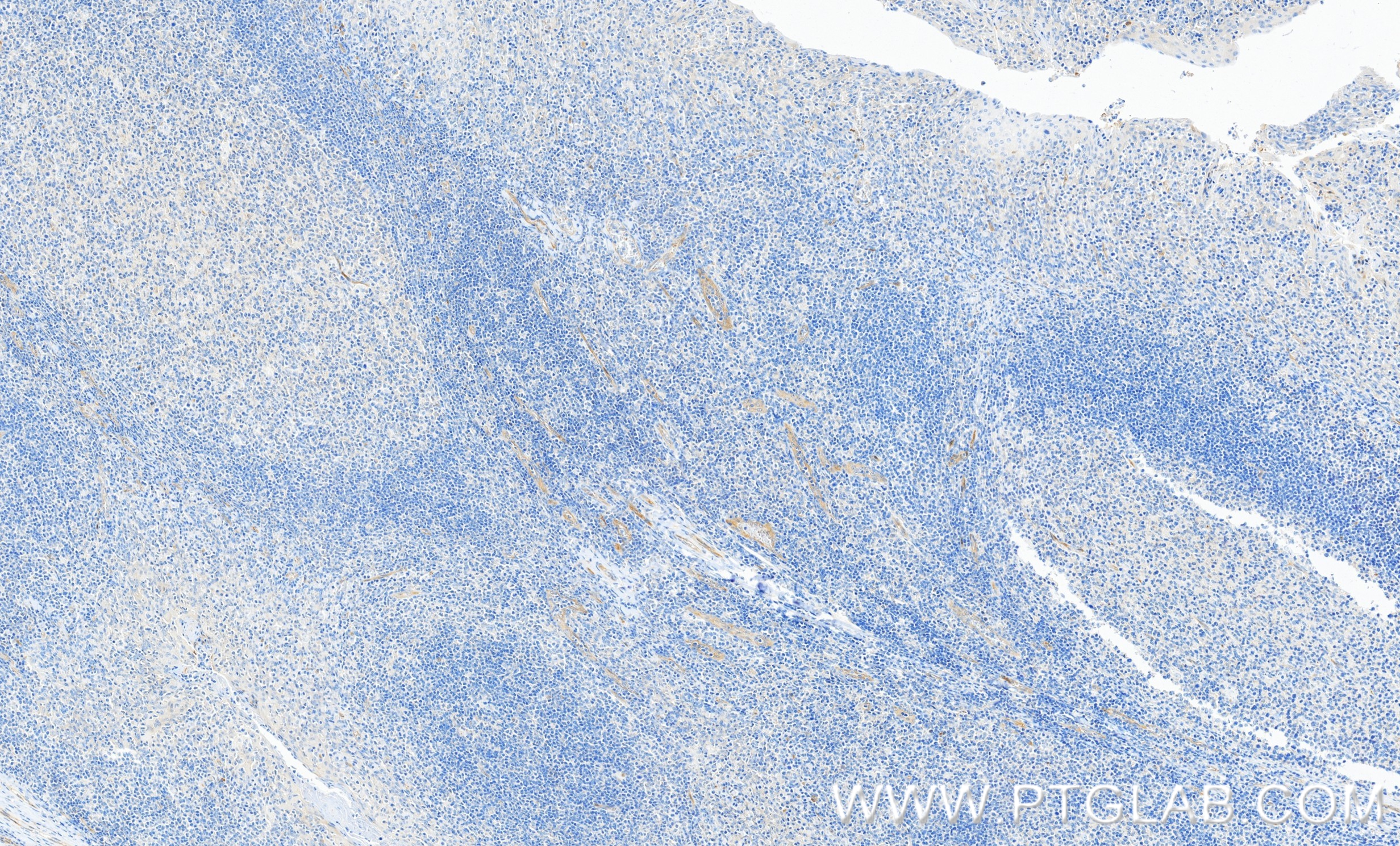 IHC staining of human tonsillitis using 81746-2-RR