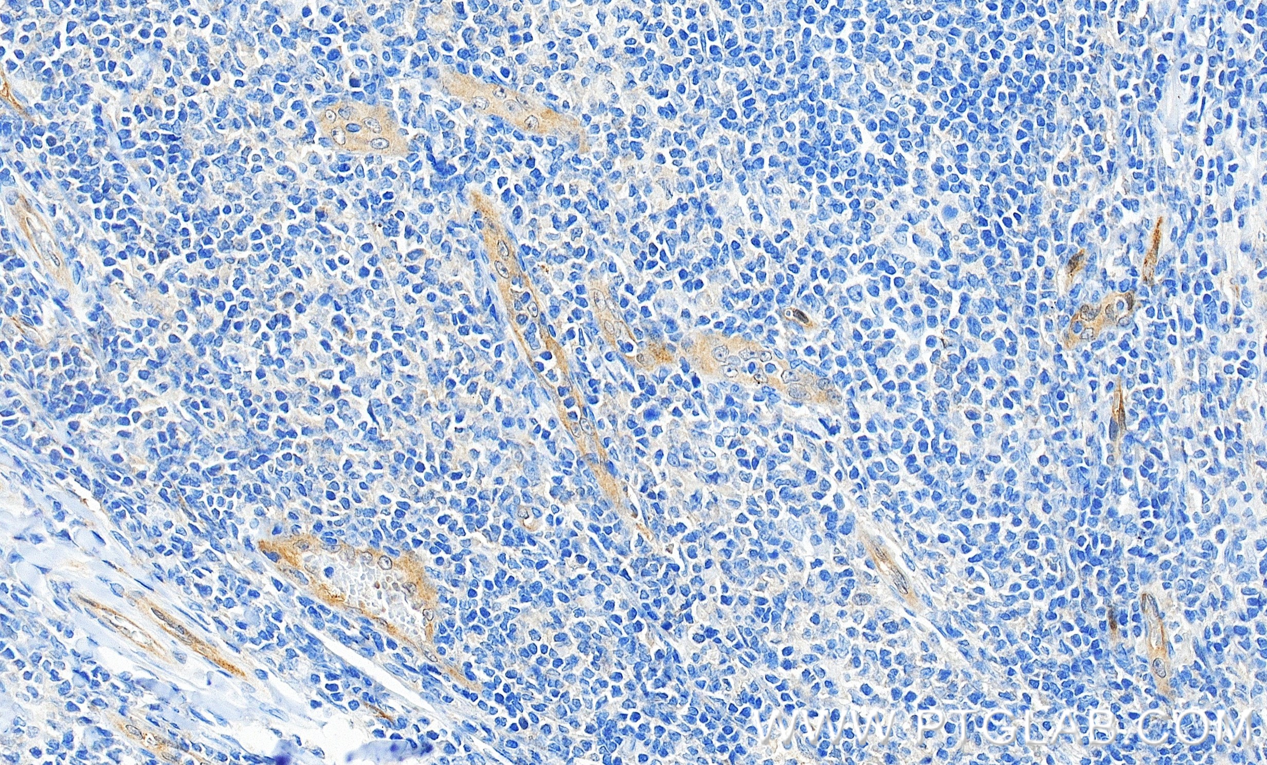 IHC staining of human tonsillitis using 81746-2-RR