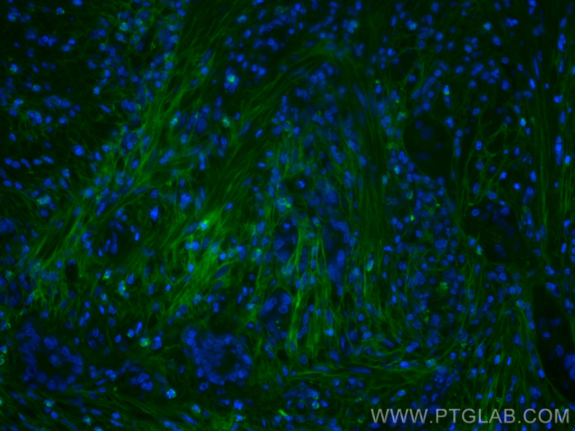 IF Staining of human colon cancer using CL488-60007