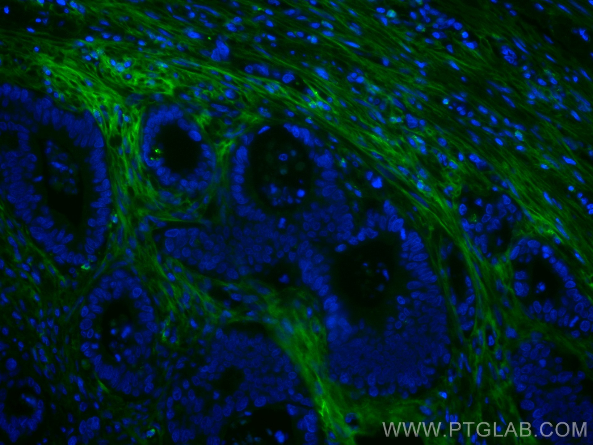 IF Staining of human colon cancer using CL488-60007