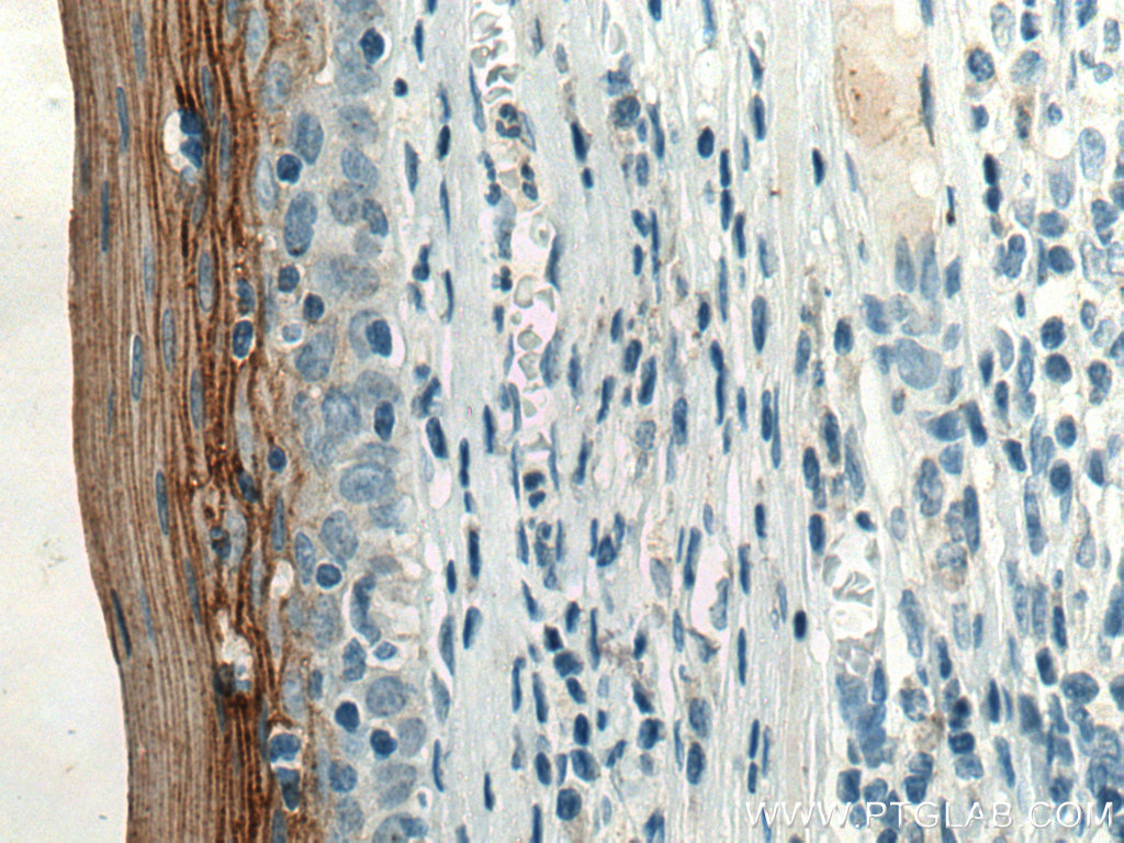 IHC staining of human tonsillitis using 67004-1-Ig (same clone as 67004-1-PBS)