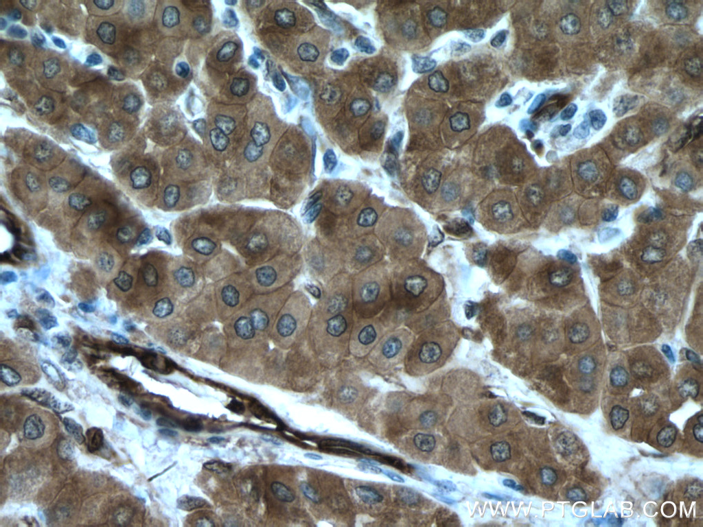 IHC staining of human liver cancer using 15100-1-AP