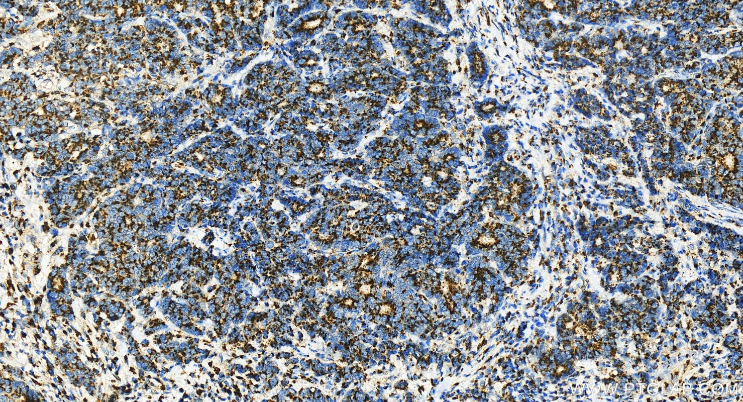 IHC staining of human stomach cancer using 13573-1-AP