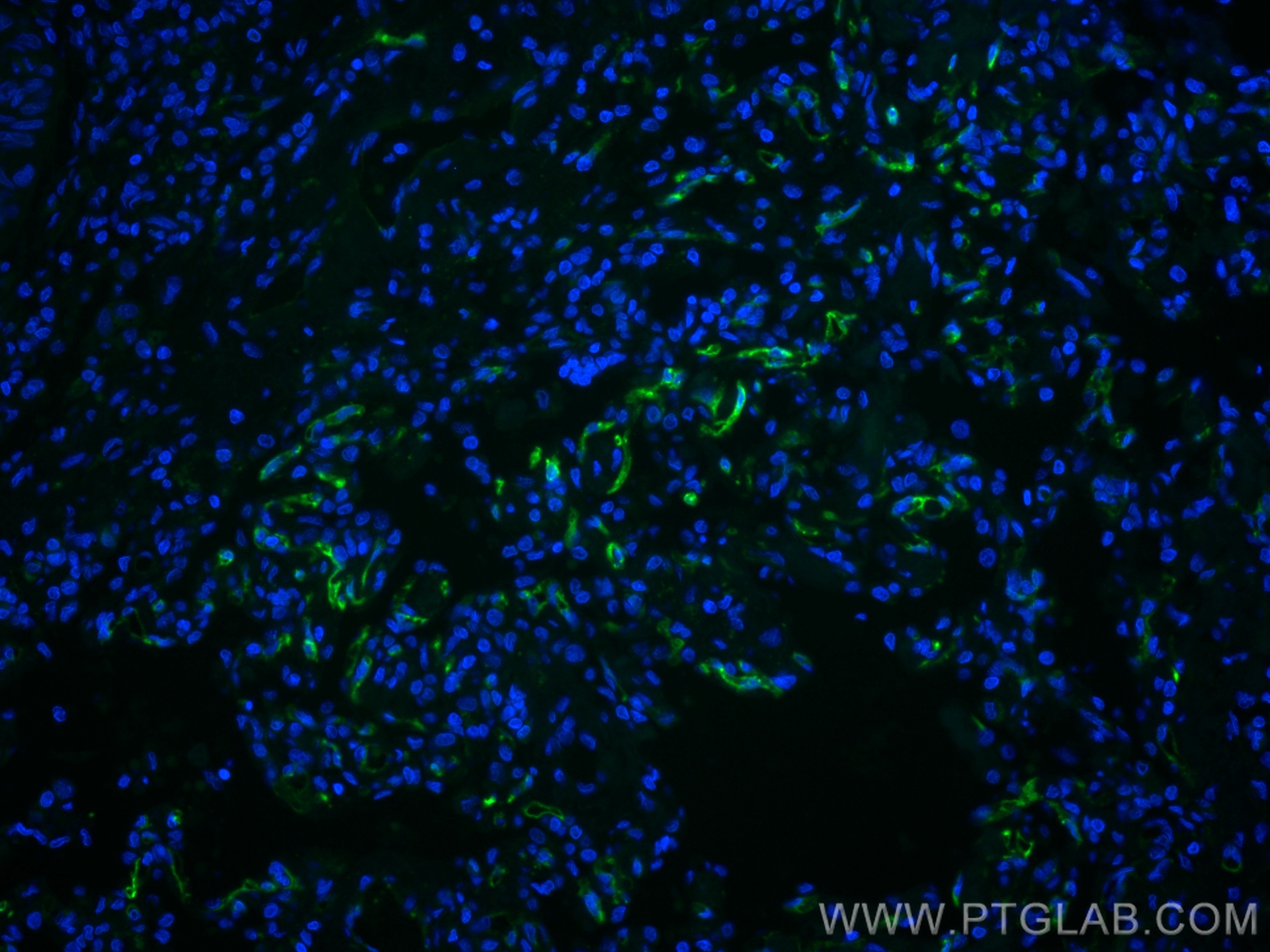 IF Staining of human lung cancer using CL488-67831