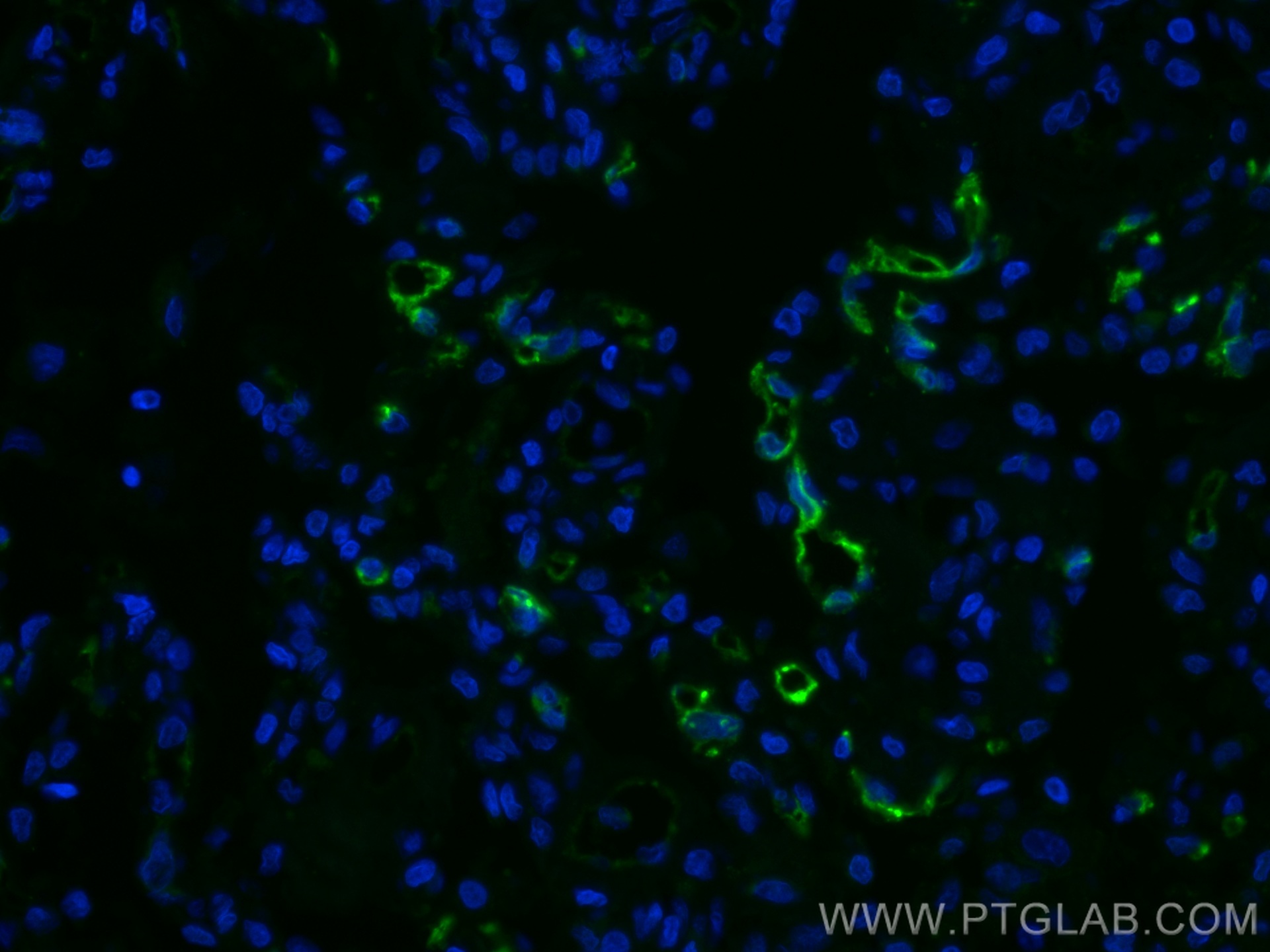 IF Staining of human lung cancer using CL488-67831
