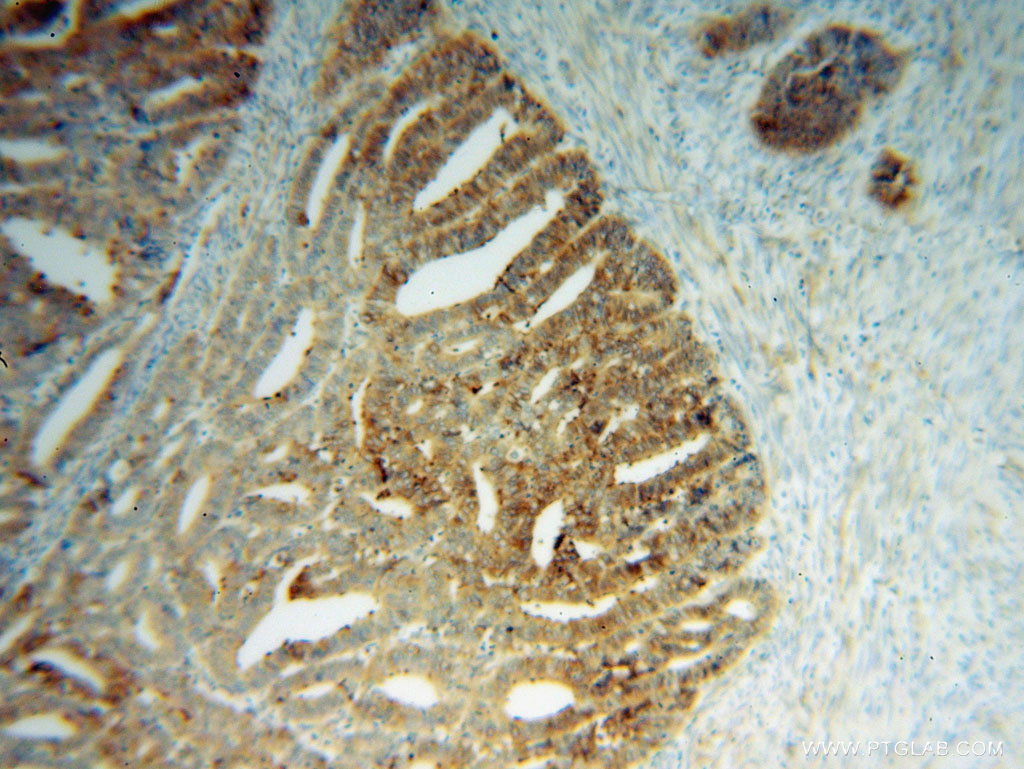 IHC staining of human endometrial cancer using 14692-1-AP