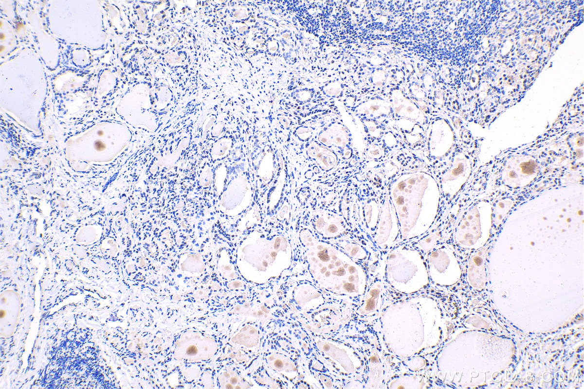 IHC staining of human thyroid cancer using 66703-1-Ig (same clone as 66703-1-PBS)