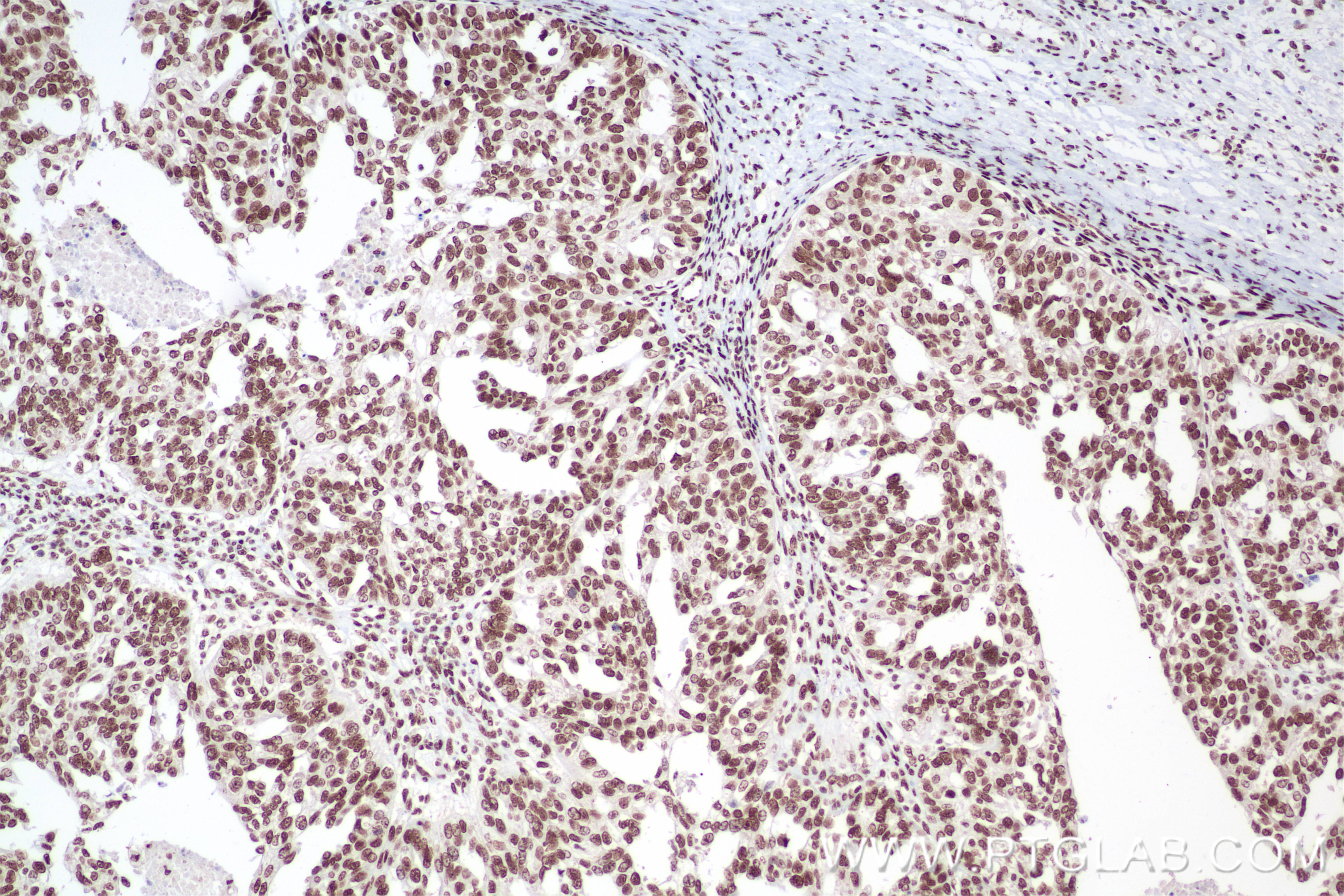 IHC staining of human ovary cancer using 85093-1-RR (same clone as 85093-1-PBS)