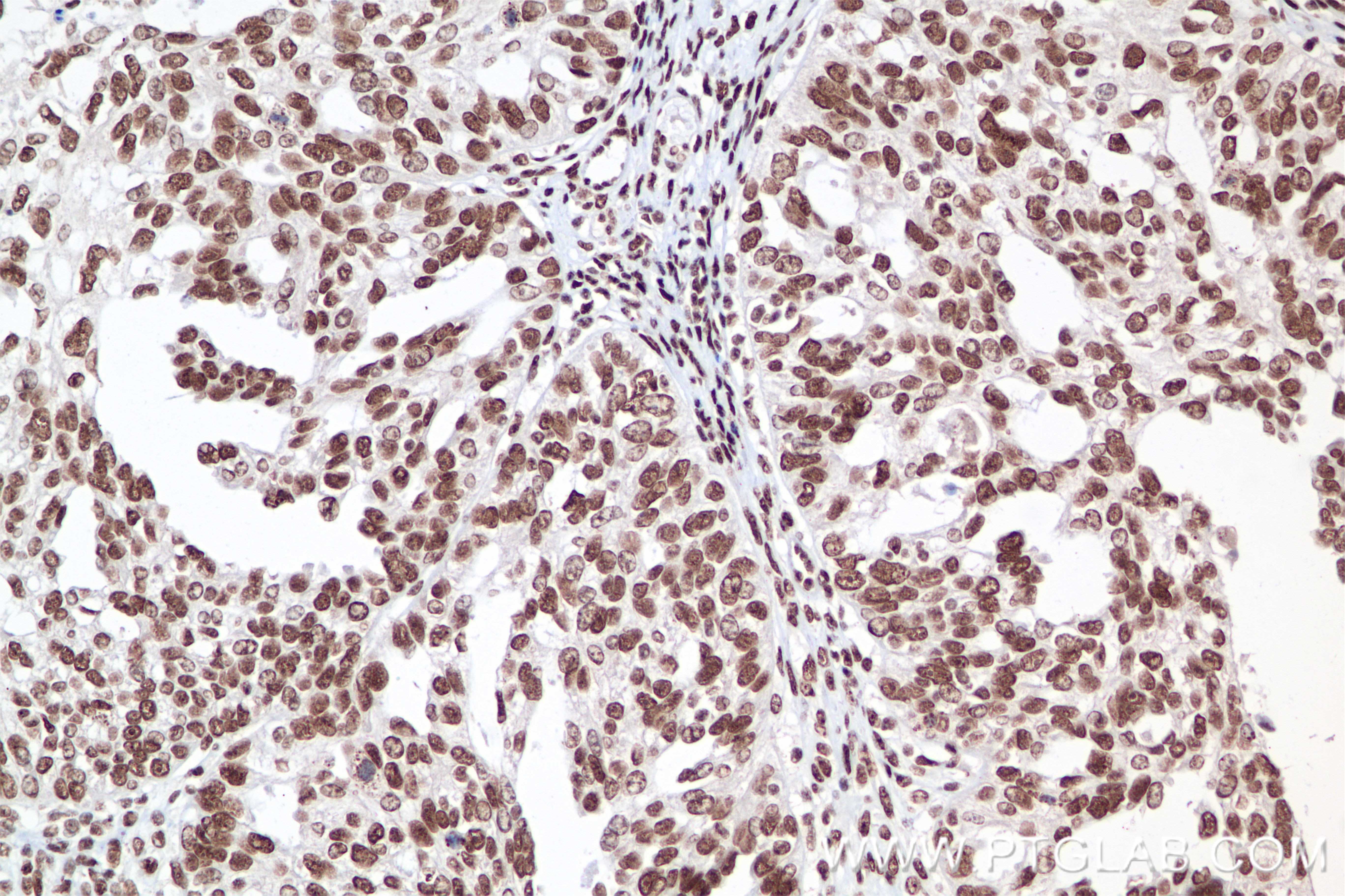 IHC staining of human ovary cancer using 85093-1-RR (same clone as 85093-1-PBS)