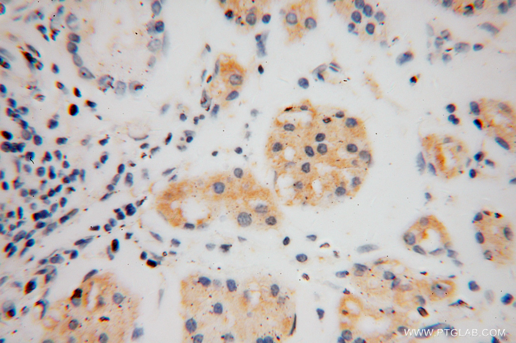 IHC staining of human stomach cancer using 15486-1-AP (same clone as 15486-1-PBS)