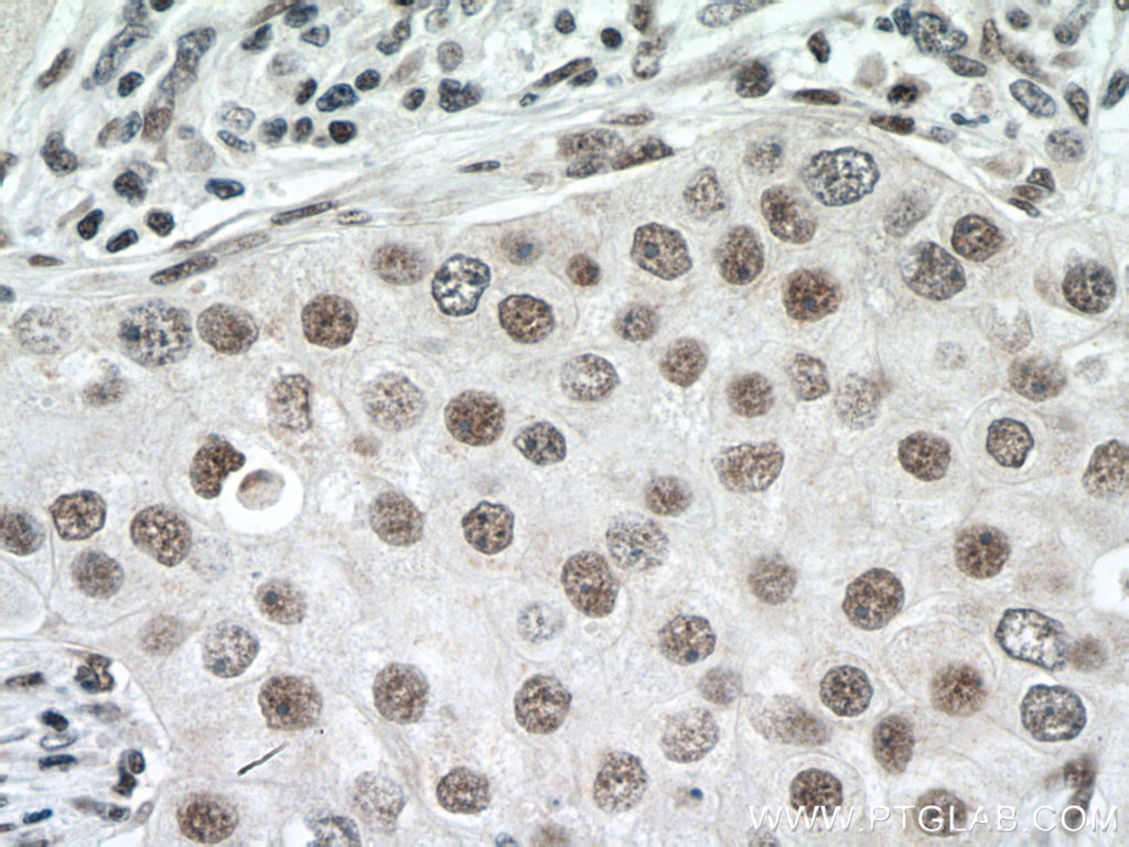 IHC staining of human breast cancer using 14921-1-AP