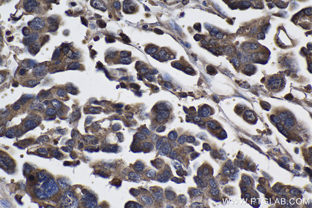 IHC staining of human colon cancer using 19807-1-AP