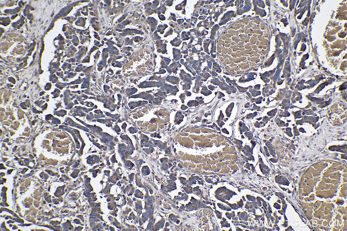 IHC staining of human colon cancer using 19807-1-AP